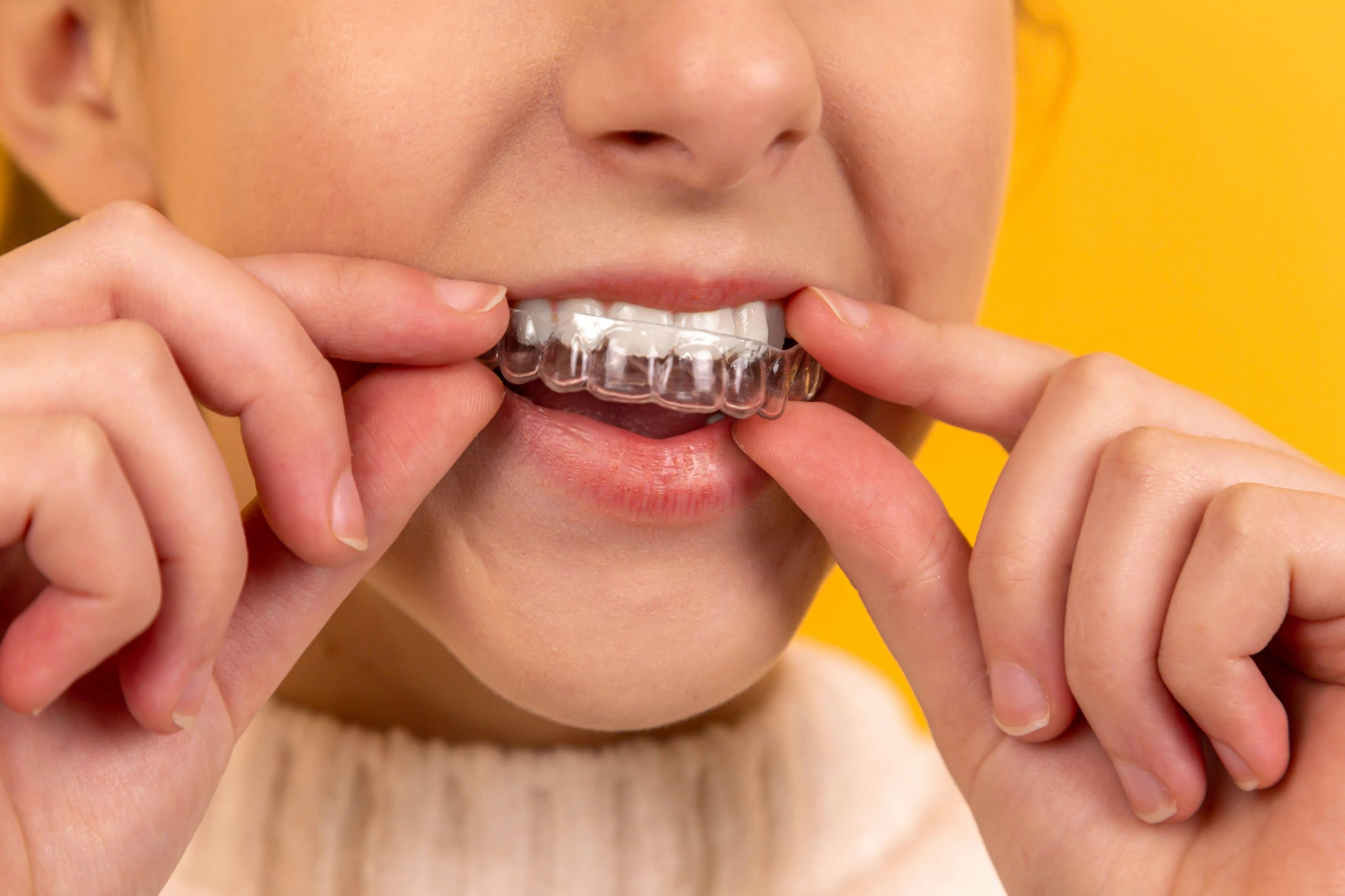 How Clear Aligners Can Improve Your Oral Health